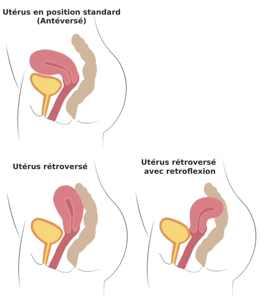 Utérus rétroversé sexualités info santé