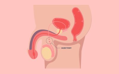 Tout savoir sur la vasectomie