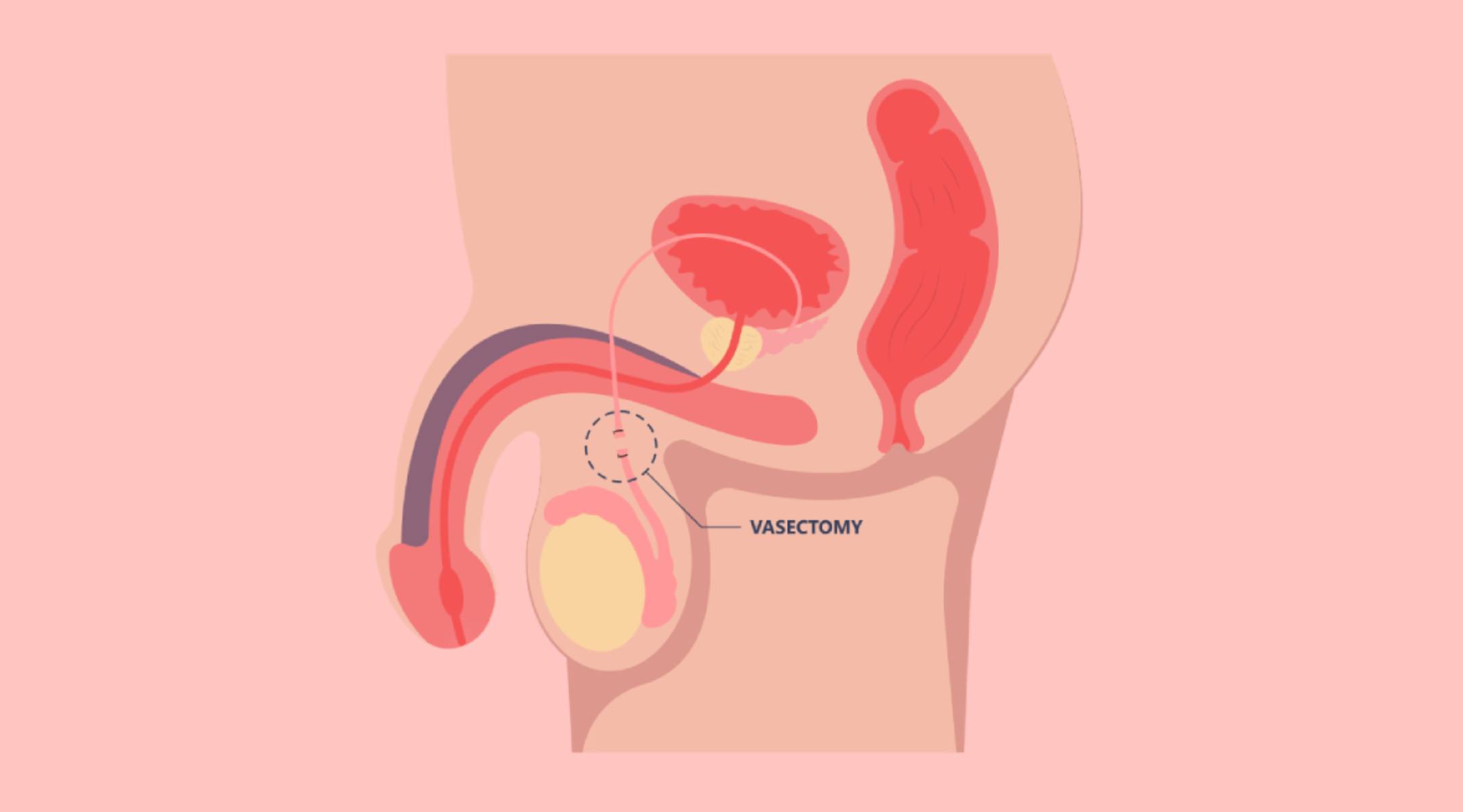 vasectomie sexualités info santé